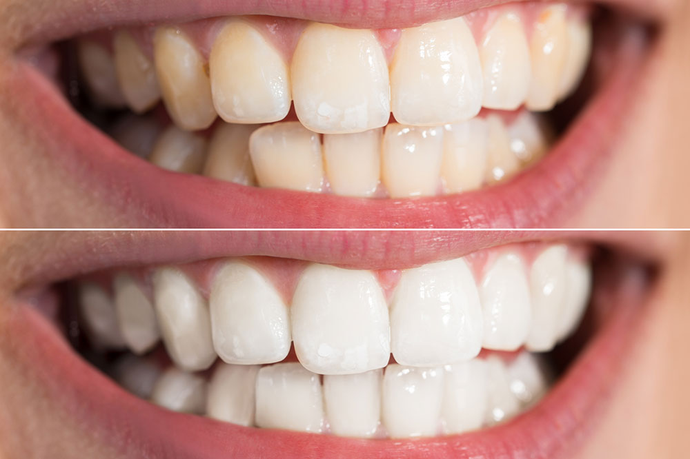 5 Ways to Effectively Whiten Teeth