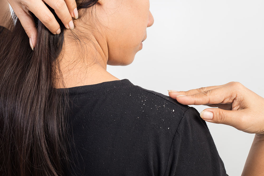 6 Essential Tips to Prevent Dandruff